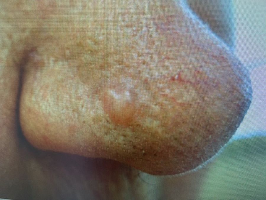 carcinoma basocelular no nariz